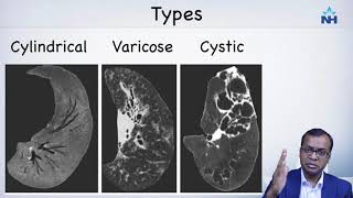 CT imaging and diagnosis of Bronchiectasis [upl. by Nohtahoj]