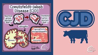 Creutzfeldt Jakob Disease CJD [upl. by Conley]