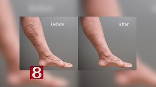 Removing Varicose Veins [upl. by Akinorev946]