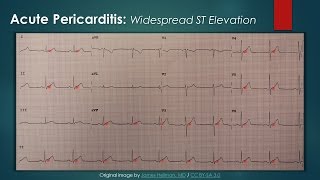 Acute Pericarditis ECG [upl. by Attennyl]