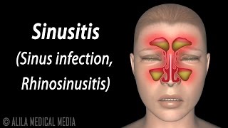 Diagnosing Sinus Infections [upl. by Nehtan741]