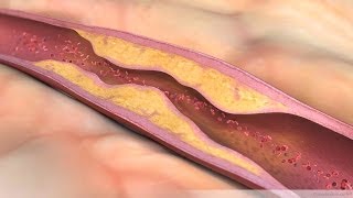 What is Atherosclerosis [upl. by Primrose689]