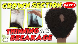 Crown SORENESS and BREAKAGE  Causes and Solutions Part 1 [upl. by Nnylassej]